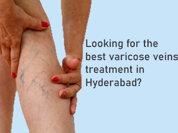 Looking for the best varicose veins treatment in Hyderabad